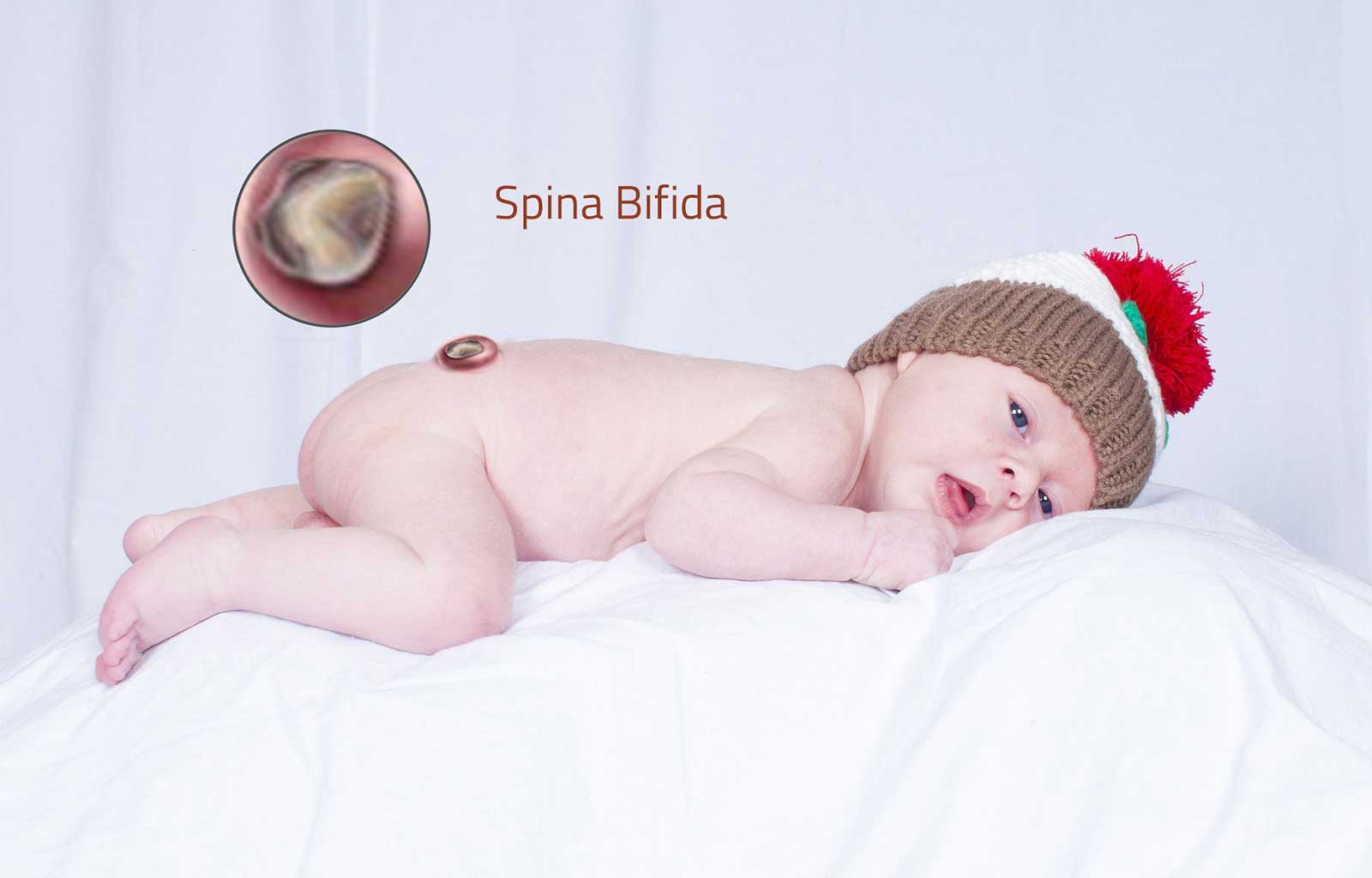 spina bifida 1