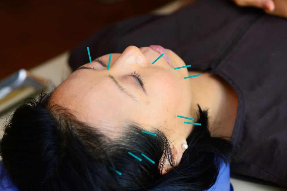Akupunktur ile Uykusuzluk